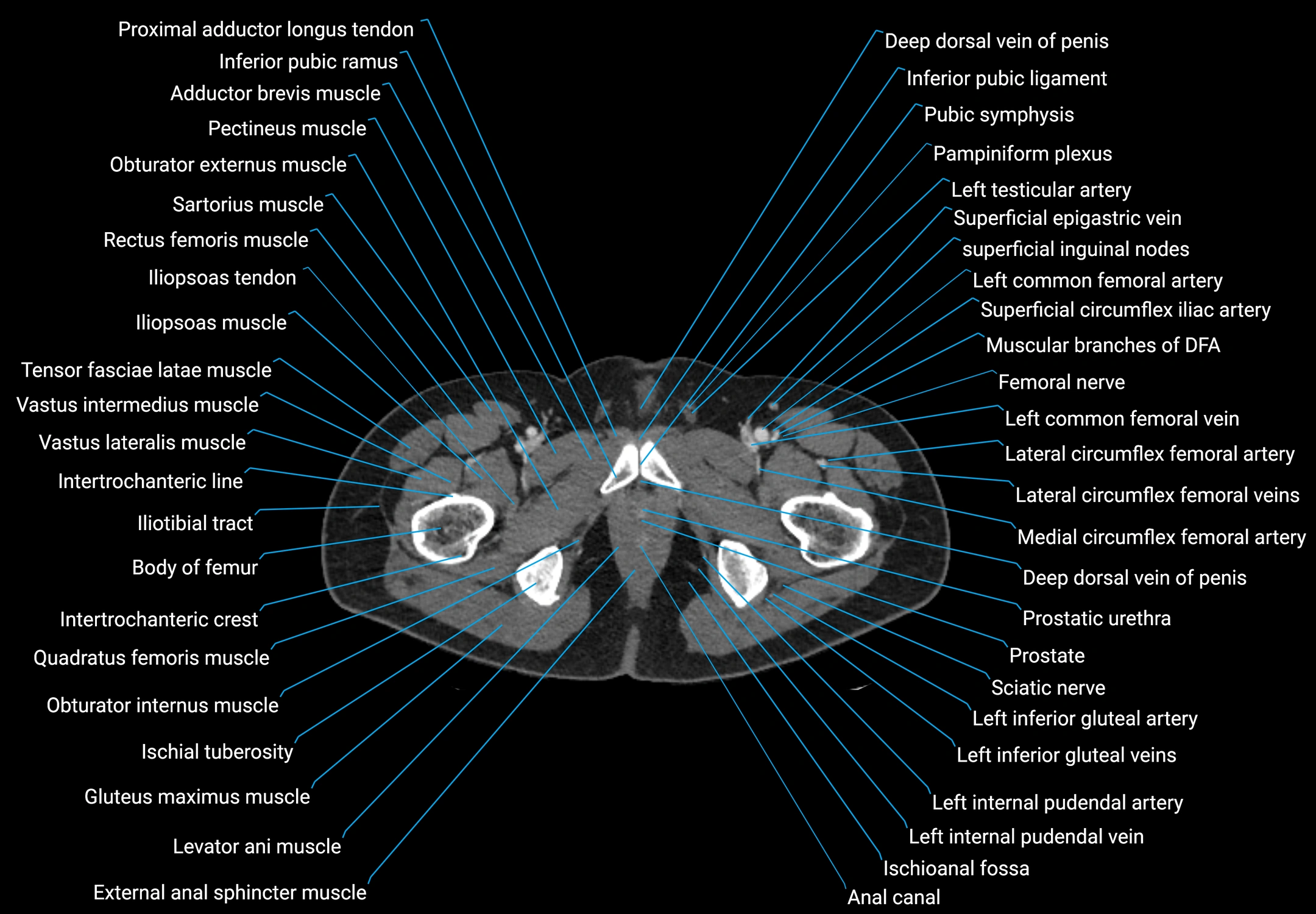 CT male pelvis axial cross sectional anatomy labelled radiology image -00205.webp